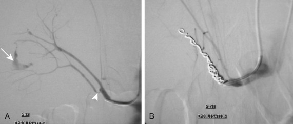 Fig. 49.6, Post-biopsy haemorrhage.