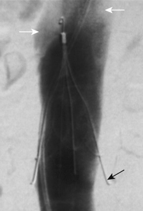 Fig. 51.1, IVC venogram performed prior to removal of IVC filter.