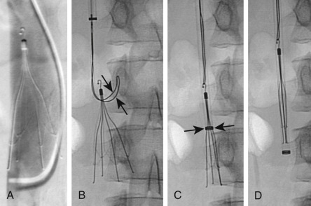 Fig. 51.2, Removal of a Gunther tulip IVC filter.