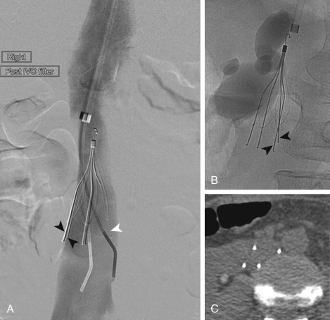 Fig. 51.4, Images of IVC filter.