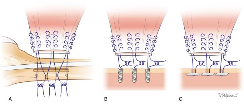 Fig. 21.1, Illustrations depict the different techniques use to secure the repair to the footprint: bone trough technique ( A ), suture anchor technique ( B ), and unicortical button technique ( C ) (authors’ preferred repair).