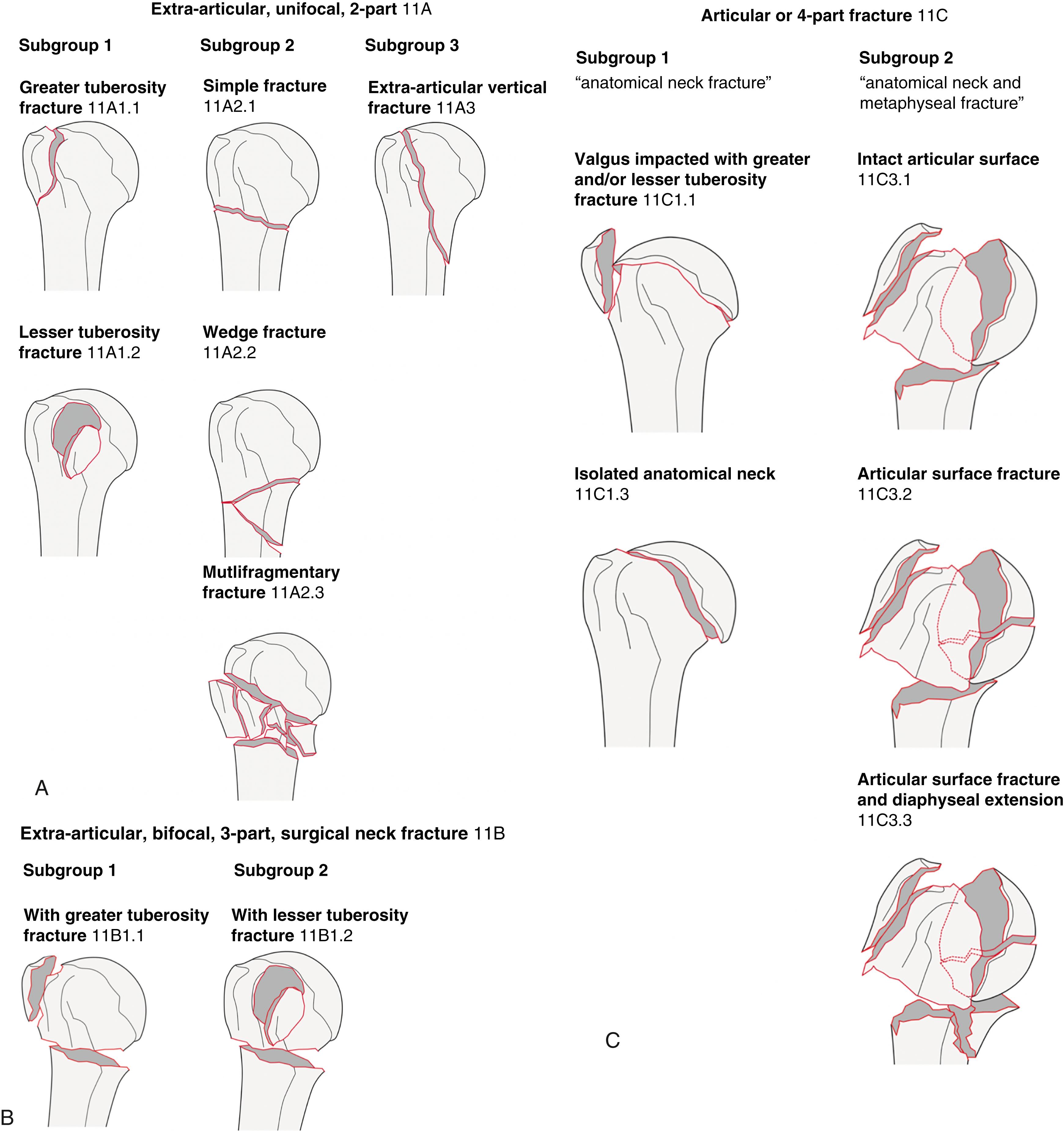 Fig. 25.3, (A–C) Description of the Arbeitsgemeinschaft für Osteosynthesefragen/American Society for Internal Fixation fracture classification of the proximal humerus. Copyright by AO Foundation, Switzerland.