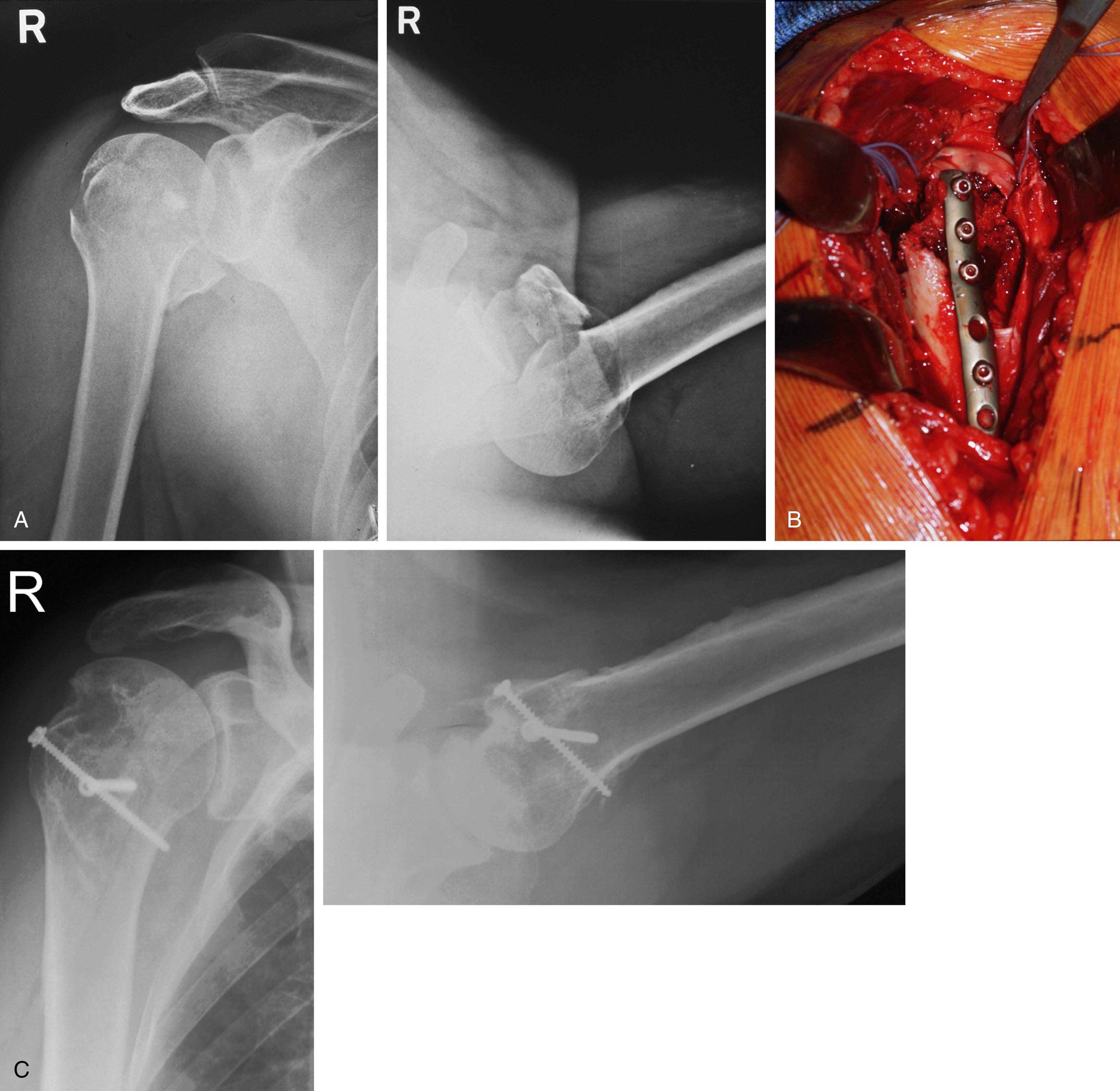 Fig. 25.5, (A) A 56-year-old man with a posterior fracture-dislocation. (B) Temporary in situ fixation with one-third tubular plate. (C) Definitive fixation of lesser tuberosity with screws, radiographic follow-up 4 years postoperatively. (D and E) Clinical follow-up 4 years postoperatively.• Fig. 25.5, cont’d