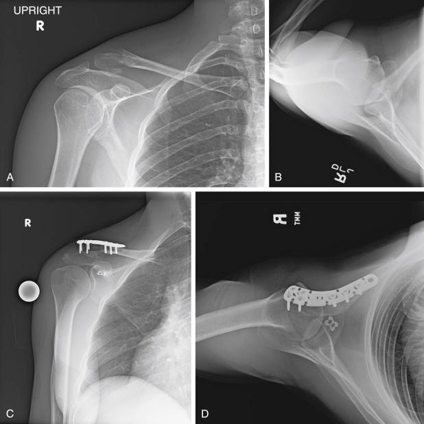 Fig. 15.1, A right-sided Neer type 5 distal clavicle fracture. A, Preoperative AP view. B, Preoperative axillary view. C, Postoperative AP view of the same shoulder after open reduction and internal fixation with a precontoured distal clavicle plate and integrated CC fixation with cortical buttons and suture tape. D, Postoperative axillary view of the same shoulder; note the cortical button underneath the coracoid process.