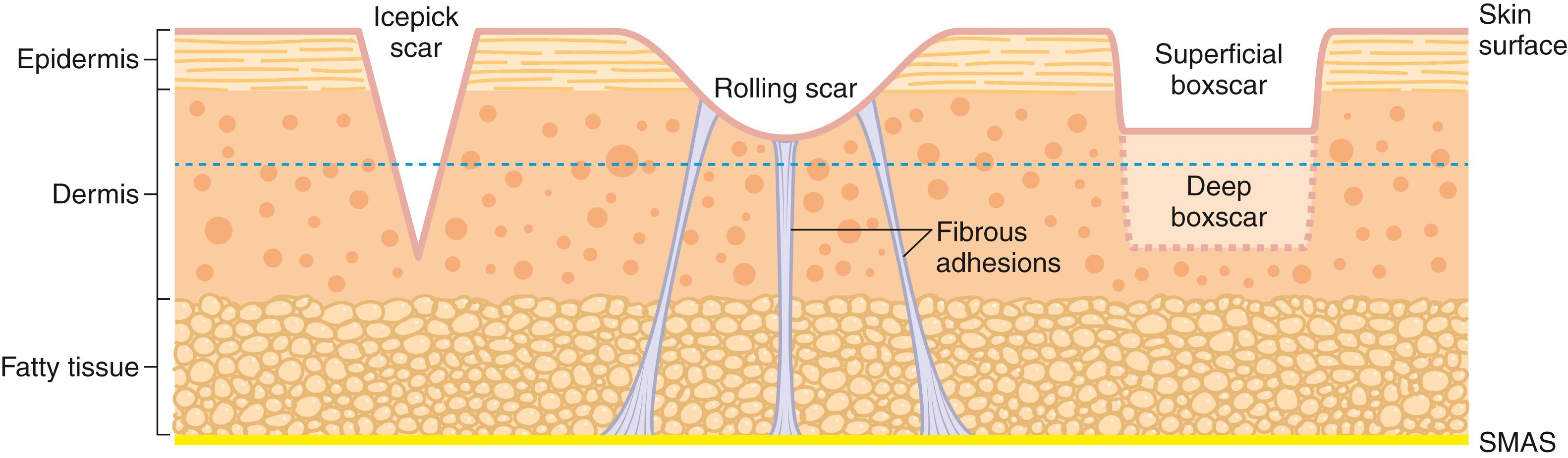 Fig. 11.1, Icepick, rolling, and boxcar (superficial and deep) scars. The yellow line represents the superficial musculoaponeurotic system to which fibrous bands adhere, creating rolling scars. SMAS, superficial musculoaponeurotic system.