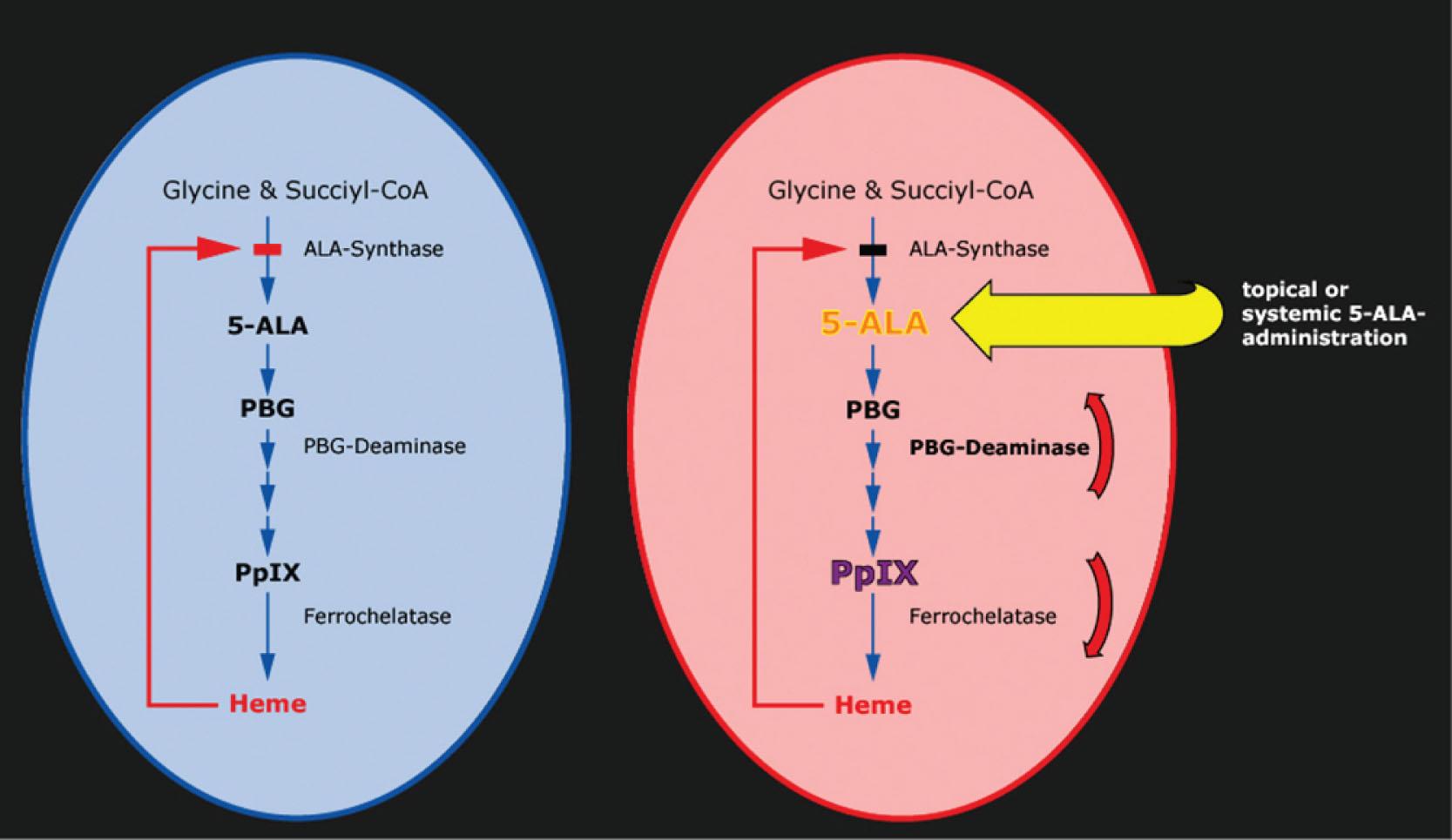 Fig. 14.1, Application of aminolevulinic acid (ALA) bypasses the rate-determining action of heme on ALA-synthase. Increased PBG-deaminase and decreased ferrochelatase activities in rapid proliferating cells result in high accumulation of protoporphyrin IX in these tissues. PpIX , protoporphyrin IX.