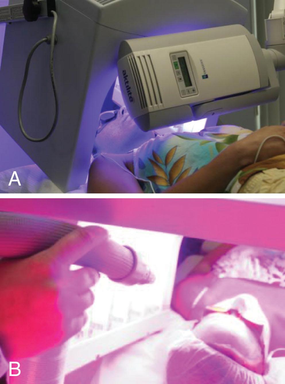 Fig. 14.4, Simultaneous treatment with red and blue light (A). Cool air is directed at the patient to maintain comfort (B).