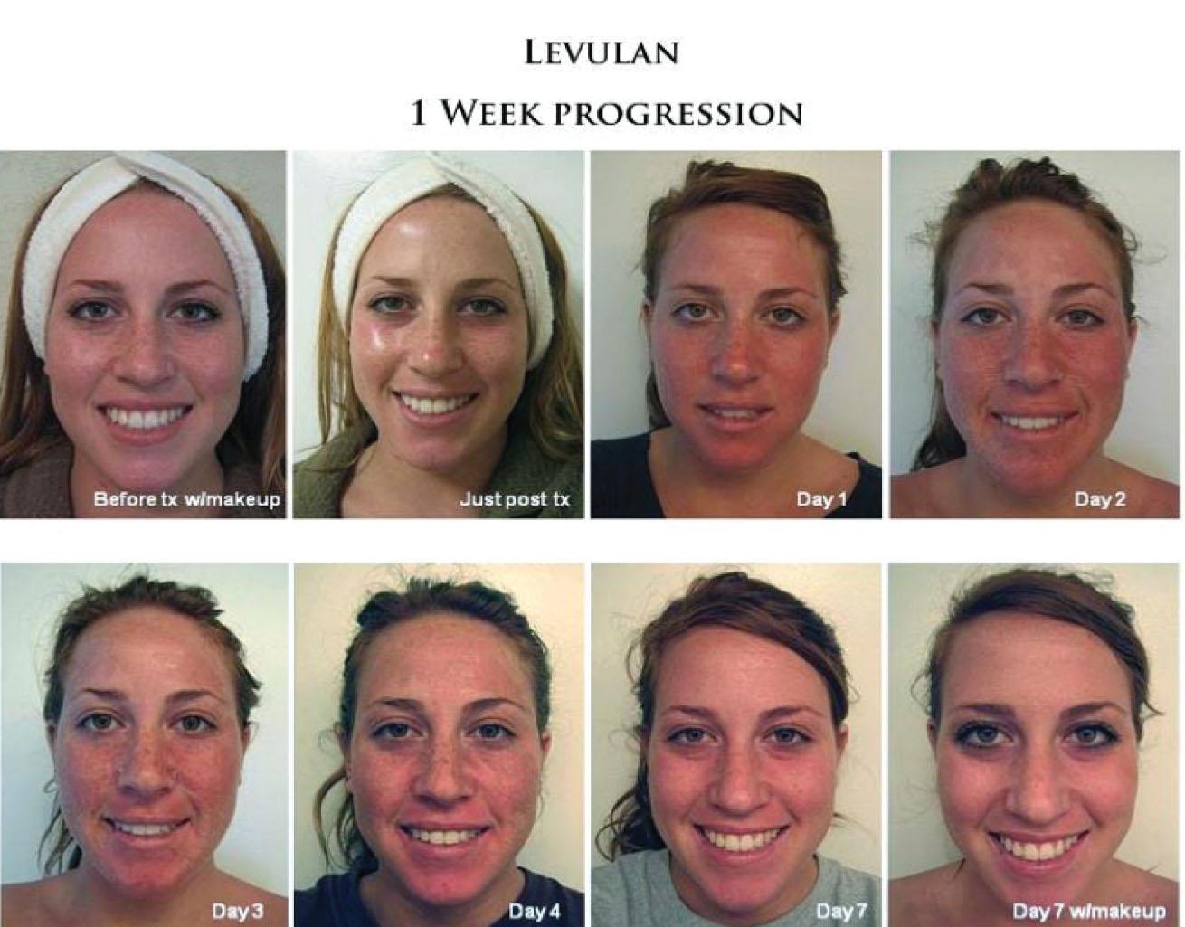 Fig. 14.5, One-week progression following treatment of acne with aminolevulinic acid-photodynamic therapy (ALA-PDT).