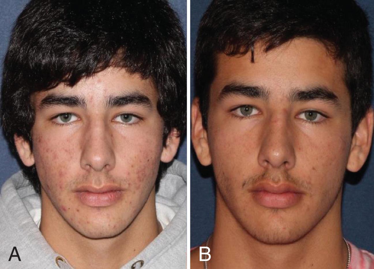 Fig. 14.6, 17-year-old status post two photodynamic therapy treatments 1 year apart with 1 year follow-up after the second treatment. Patient was treated with 1 hour incubation of aminolevulinic acid, followed by pulsed-dye laser and simultaneous red and blue light.