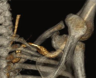 FIGURE 1, Posterior view of a three-dimensional computed tomography angiogram of a patient presenting with acute upper extremity embolization. An aneurysm is present distal to the point of compression of the subclavian artery as it crosses over a complete cervical rib.