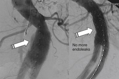 FIGURE 1, Migration of an AneuRx graft 3 years after insertion, resulting in a type Ia endoleak (left) treated with aortic cuff extension (right) .