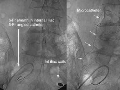 FIGURE 3, A coaxial system with microcatheters allows navigation of small retroperitoneal circuits while maintaining access into the main trunks, avoiding accidental loss of access and incorrect deployment of the coil.