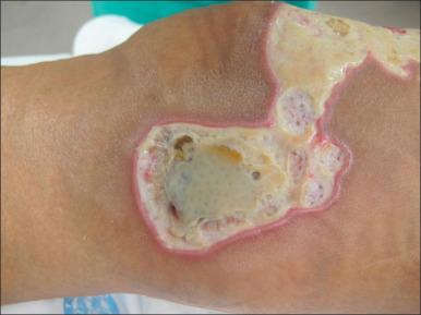 Fig. 11.1, Burn wound colonization. Flame burn to the left medial arm depicted post-burn day 7. The eschar has degraded but is still present. However, the surrounding tissue is not cellulitic.