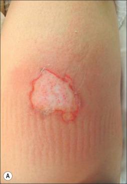 Fig. 11.2, Burn wound erythema. A hot oil scald burn on the lateral thigh is depicted with (A) surrounding erythema noted on post-burn day 2. (B) Resolution of redness and healing on post-burn day 12.