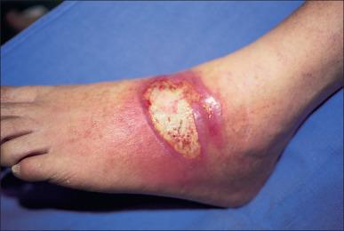 Fig. 11.3, Burn wound cellulitis. Cultures demonstrated Staphylococcus aureus . Clinical findings include increased pain, local inflammatory signs, and fever. Treatment includes systemic and topical antibiotics, excision, and autografting.