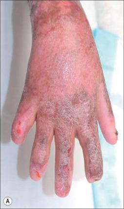 Fig. 11.4, Burn wound impetigo. Right hand in a 13-year-old boy with 85% TBSA burn, third-degree to the hands shown (A) 4 months post-burn at hospital discharge. (B) Three weeks later the patient presented with reopening of the previously taken skin grafts to the hand and clinical impetigo. Cultures were positive for MRSA, and the patient was treated with vancomycin, mupirocin, and tub therapy.