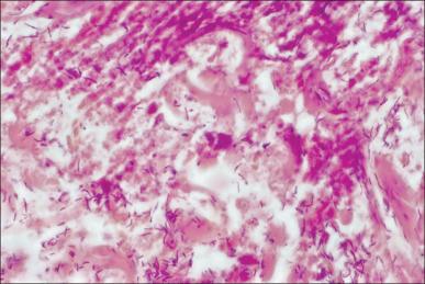 Fig. 11.6, Gram-negative bacilli invading deep viable tissue. Histopathologic confirmation is the gold standard test to diagnose burn wound infection by bacteria in viable tissue. Shown is a typical hematoxylin and eosin stained section at 1000× magnification.
