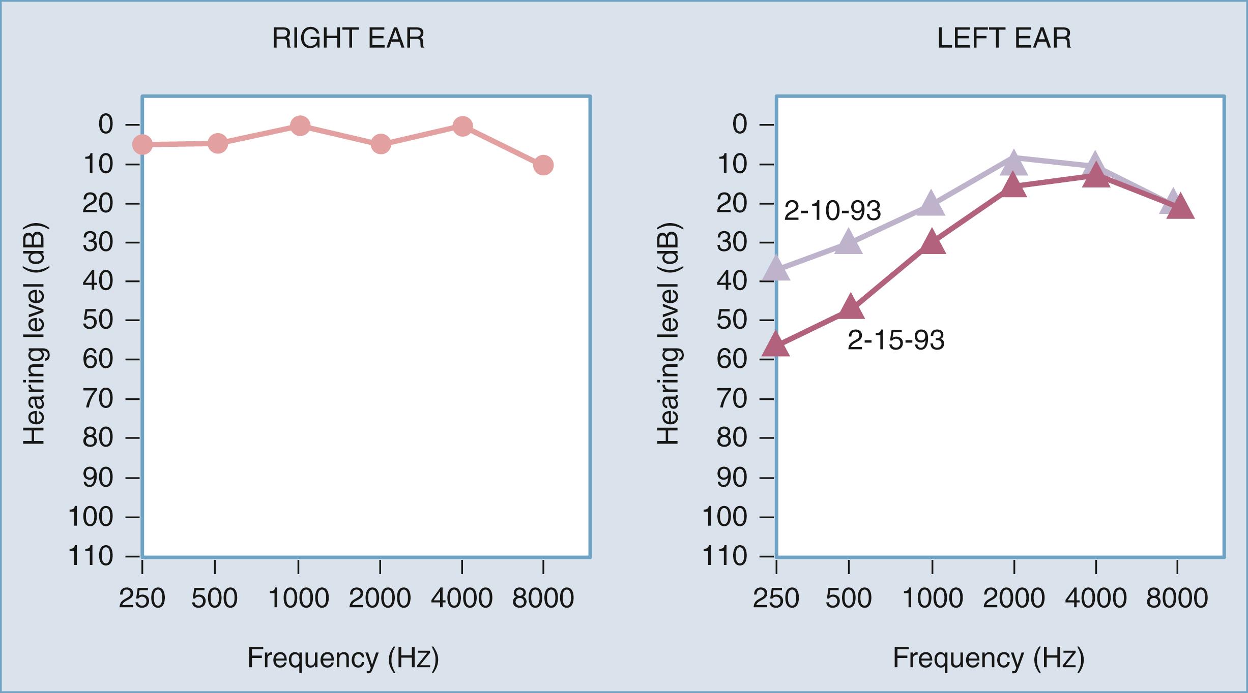 Figure 128.1, The typical audiometric findings in unilateral Meniere disease.