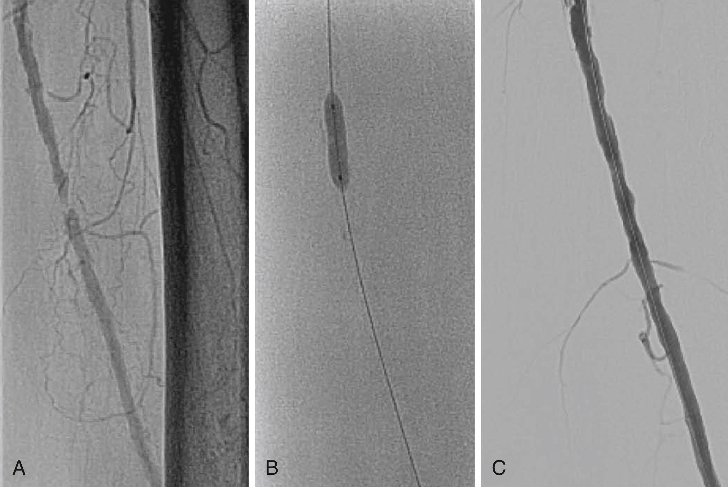 FIGURE 44.2, Treatment of a mid–superficial femoral artery stenosis (A), with balloon angioplasty alone (B), with an excellent final result (C).