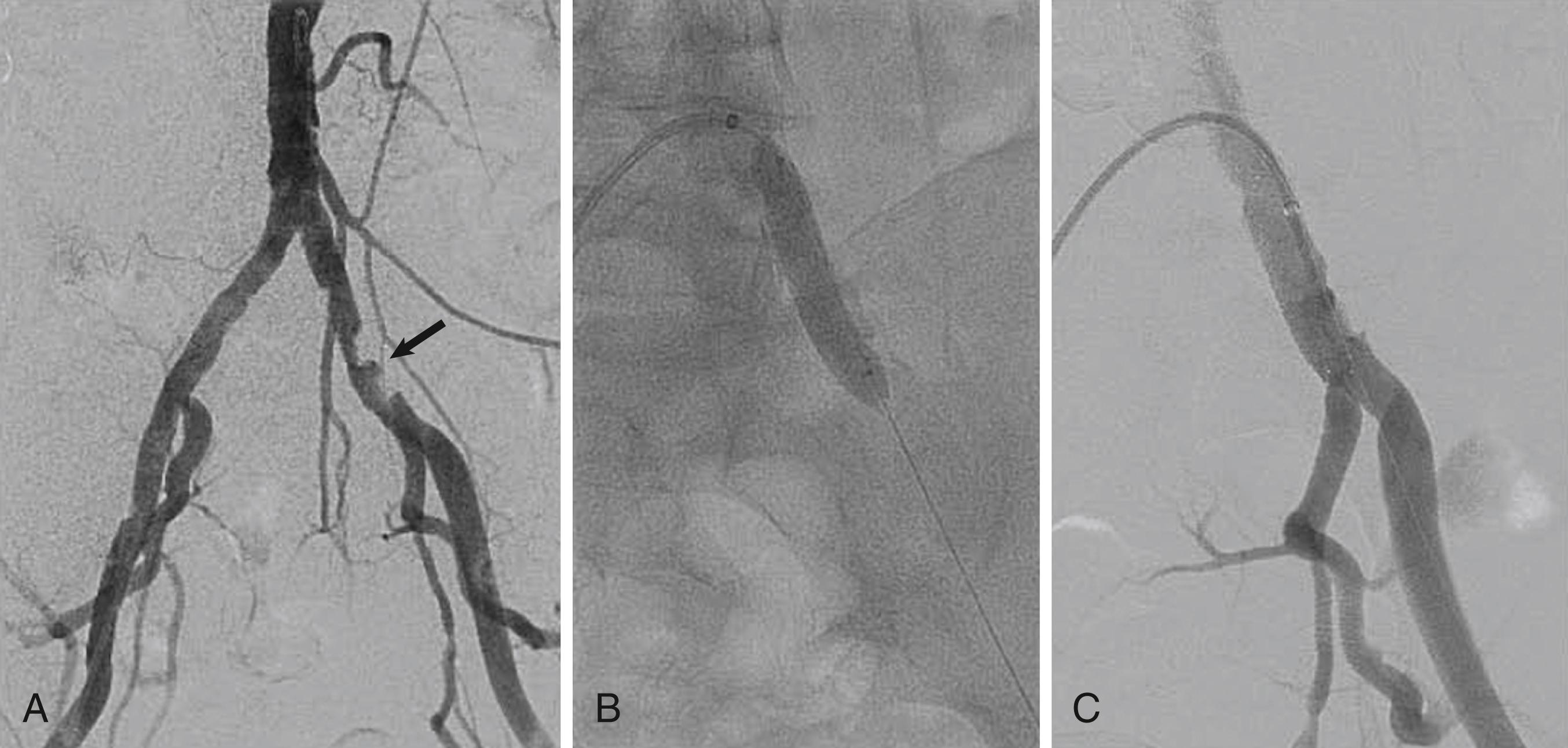 FIGURE 44.3, Treatment of left common iliac stenosis with a balloon-expandable stent from the contralateral right femoral artery. A, Serial stenoses in the left common iliac artery (arrow). B, Balloon-expandable stent deployment. C, Final angiogram.