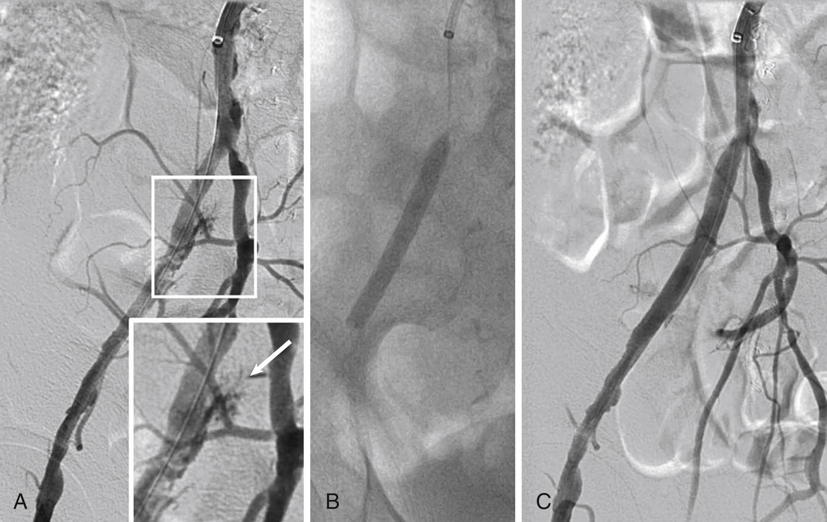 eFIGURE 44.2, Treatment of a perforated external iliac artery with a covered balloon expandable stent. A, Perforation after directional atherectomy shown enlarged in the lower right box (arrow). B, Deployment of a balloon-expandable covered stent. C, Final angiogram with the perforation sealed.