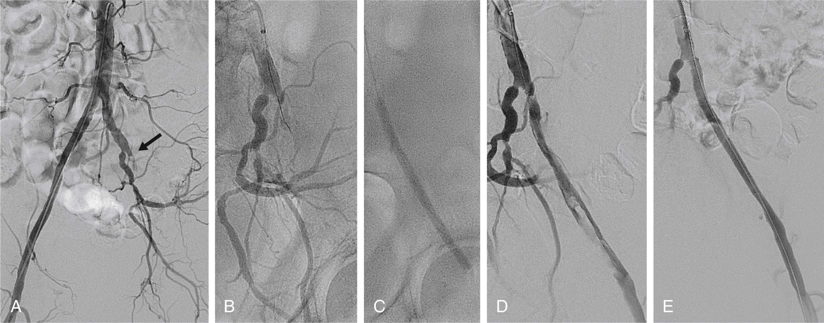 eFIGURE 44.3, Treatment of an external iliac artery dissection with a covered self-expanding stent. A, Occluded left external iliac artery (arrow). B, Wire entering the occlusion using a sheath from the contralateral femoral access. C, Balloon angioplasty. D, Extensive dissection of the left external iliac artery associated with lower abdominal pain. E, Final angiogram following deployment of a self-expanding covered stent.