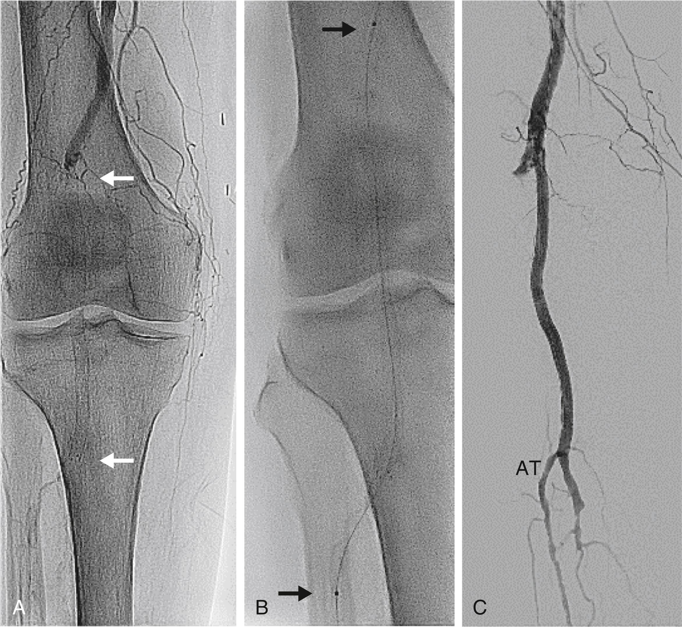 FIGURE 44.4, Catheter-based thrombolysis of a thrombosed and occluded right popliteal artery stent.