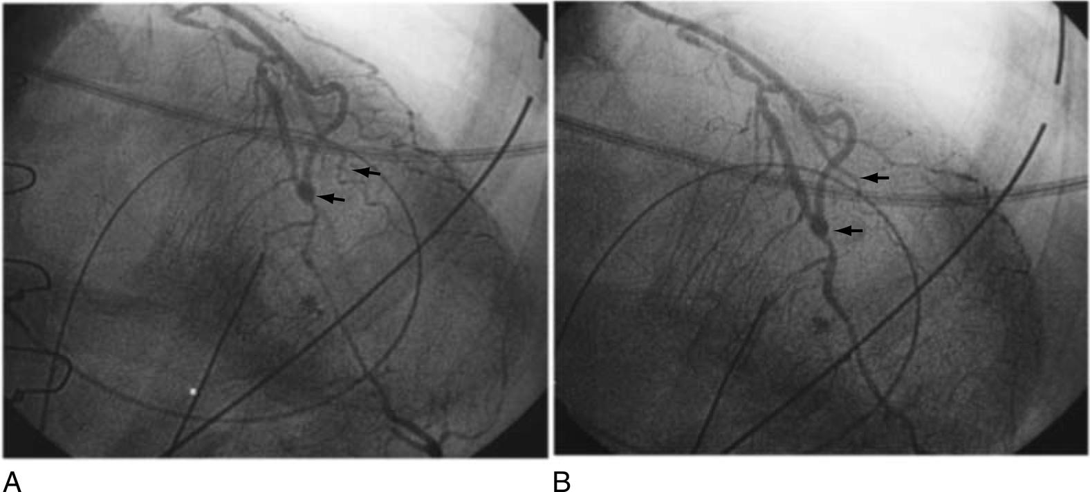 Fig. 13.11, Coronary artery spasm after coronary artery bypass grafting (CABG). (A) Postoperative coronary angiogram showing the left anterior descending artery (LAD) coronary artery spasm just distal to the left internal mammary artery (LIMA) to LAD anastomosis and the first diagonal coronary artery spasm. (B) Postoperative angiographic control after intracoronary verapamil and nitroglycerin infusion produced relief of the coronary spasm.