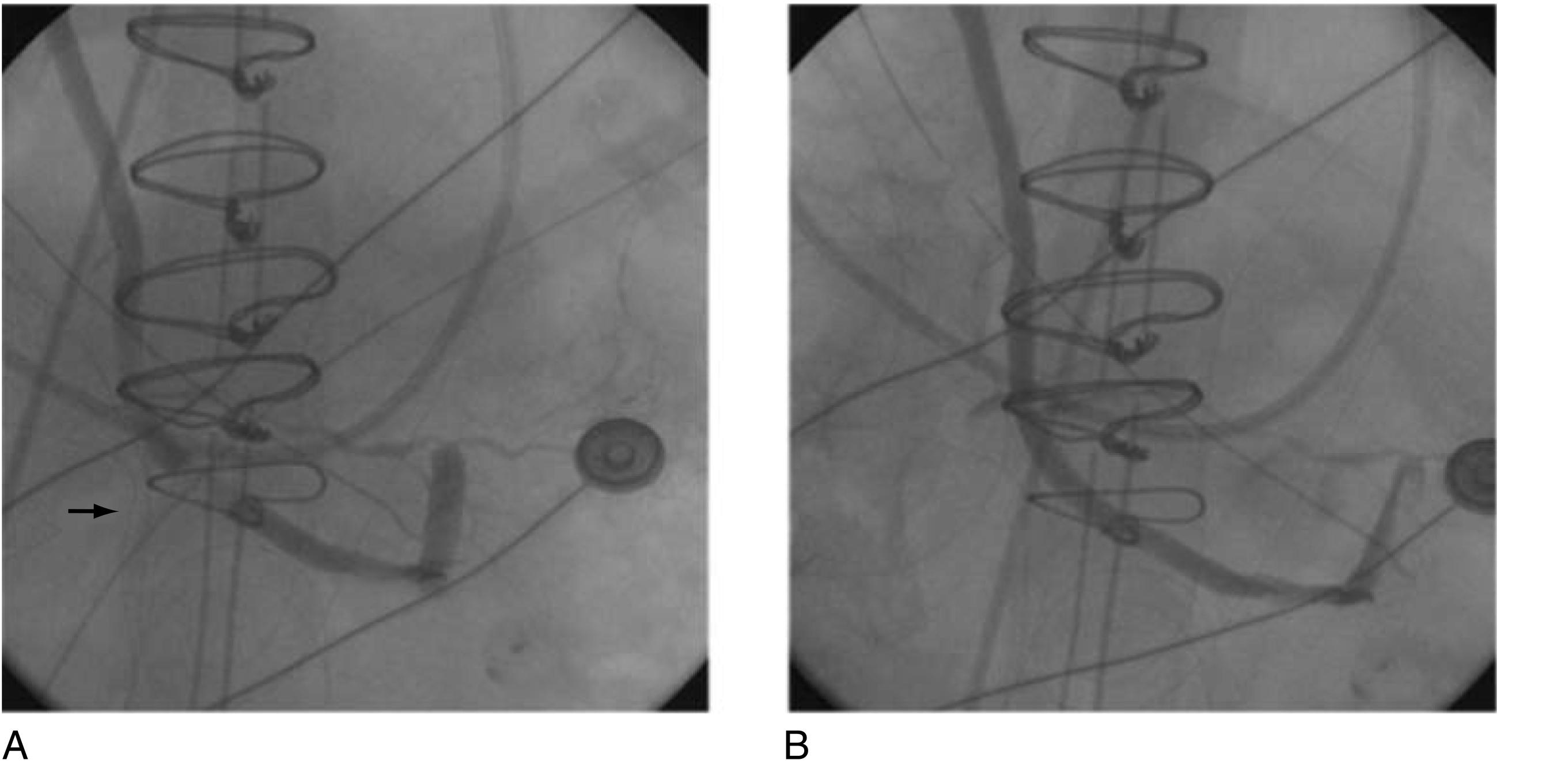 Fig. 13.12, Angiogram for perioperative myocardial infarction after coronary artery bypass grafting. (A) The saphenous vein graft to the posterior descending artery was externally compressed by a mediastinal chest tube (arrow) . (B) Obstruction was relieved by removal of tube.