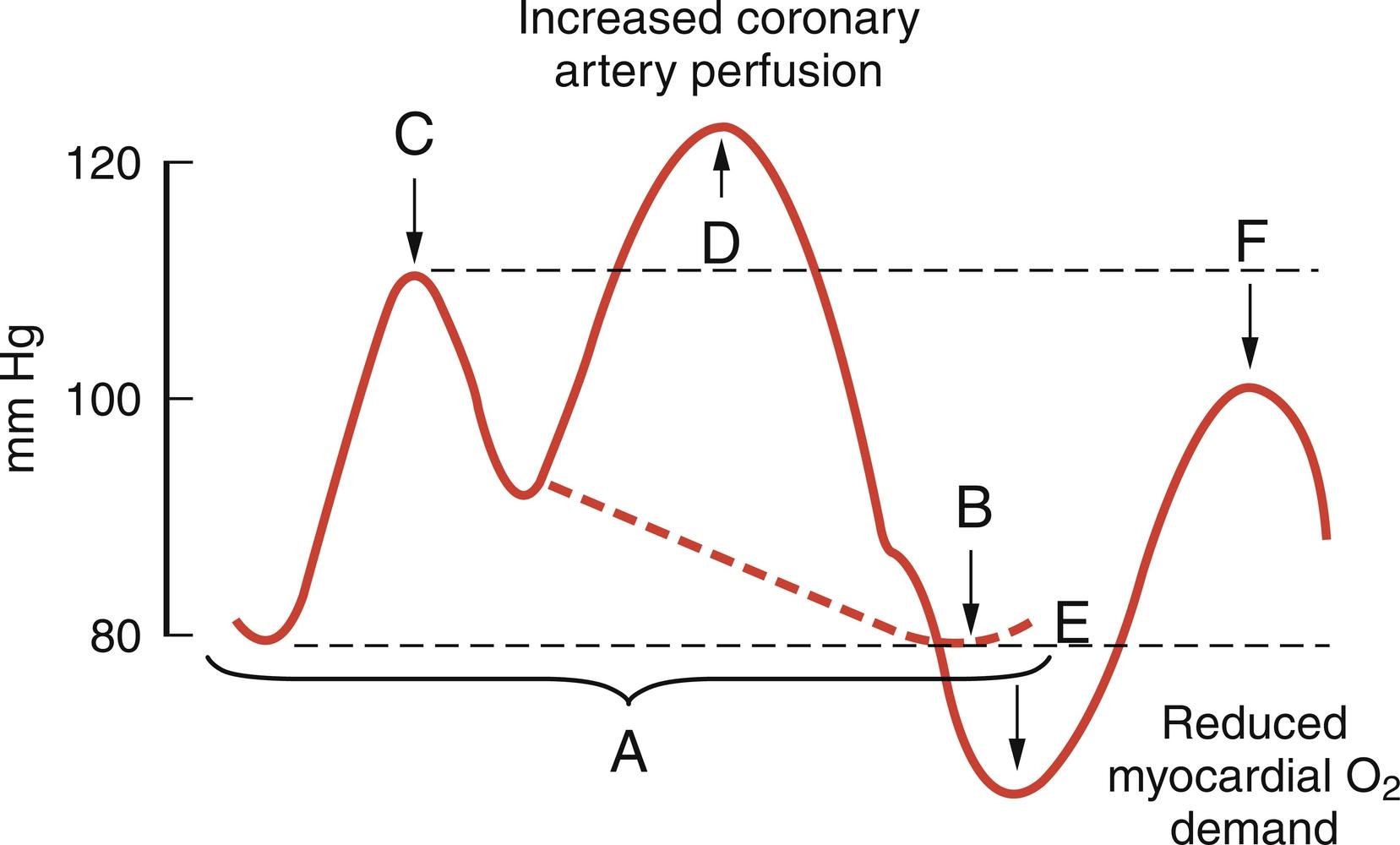 Fig. 13.13, Intra-aortic balloon pump (IABP) timing: synchronization with the cardiac cycle. Arterial pressure waveform with correct IABP timing. (A) One complete cardiac cycle. (B) Unassisted aortic end-diastolic pressure. (C) Unassisted systolic pressure. (D) Diastolic augmentation. (E) Reduced aortic end-diastolic pressure. (F) Reduced assisted systolic pressure.