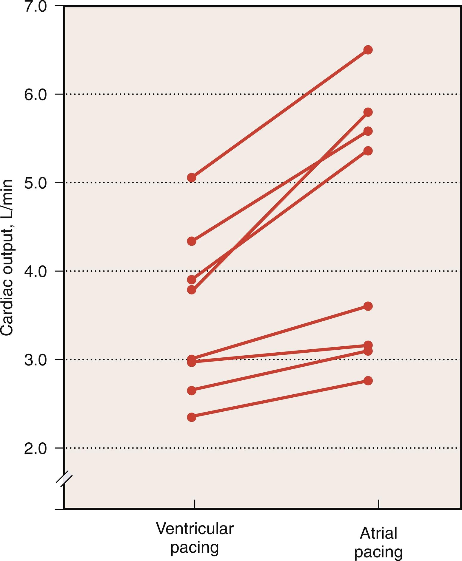 Fig. 13.15, Effect of atrioventricular (AV) synchrony on cardiac output after cardiac surgery. Cardiac output with ventricular pacing (without synchronous atrial systole) is compared with cardiac output with atrial pacing. An overall increase in cardiac output of approximately 26% is achieved with A-pacing and restoration of AV synchrony with left ventricular end-diastolic preload augmentation.