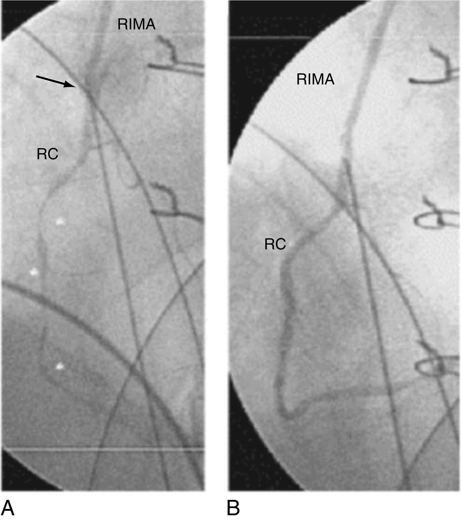 Fig. 13.9, Treatment of right coronary artery (RCA) spasm after coronary artery bypass grafting (CABG). (A) Coronary artery angiogram showing a diffuse spasm of the RCA beyond the level of the anastomosis (arrow) with the right internal mammary artery (RIMA). (B) RCA spasm resolution after intracoronary infusion of nitroglycerin.