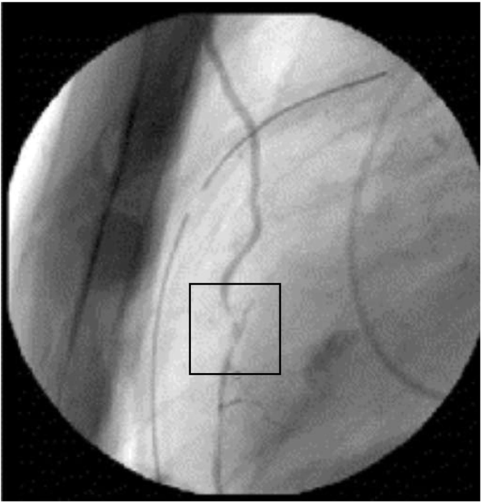 Fig. 13.10, Postcoronary artery bypass grafting (CABG) angiography. Narrowing of a left internal mammary artery to left anterior descending artery bypass graft (square) . The segment above the anastomosis and the toe of the anastomosis are stenotic. There was no response to intraluminal nitroglycerin. This graft underwent surgical revision. At revision, the upper stenosis was diagnosed to be a spasm, which had been fixed by fibrin glue. The stenosis at the toe was the result of surgical technique. After revision, an open anastomosis and perfect flow were present.