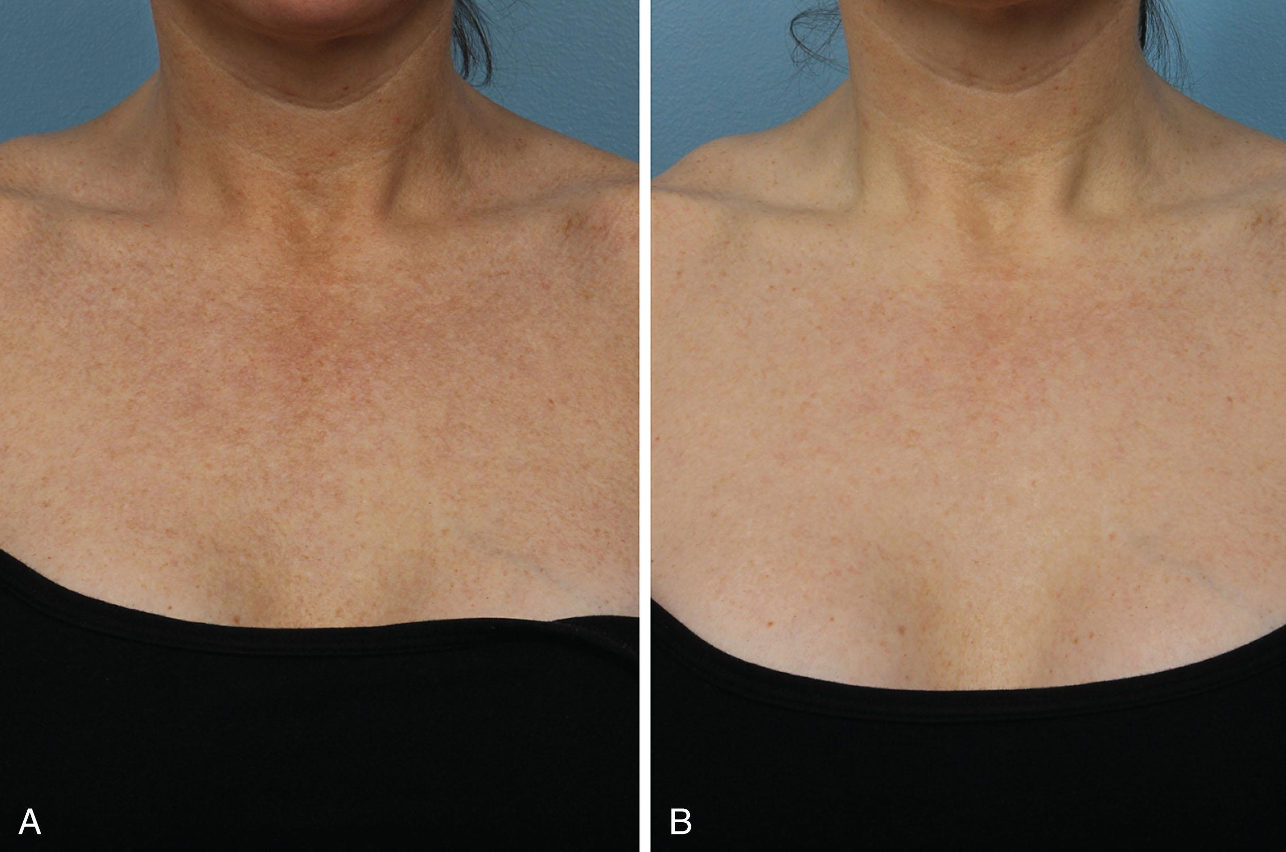 Fig. 5.1, Before and after a single treatment with BBL HERO for chest photoaging.