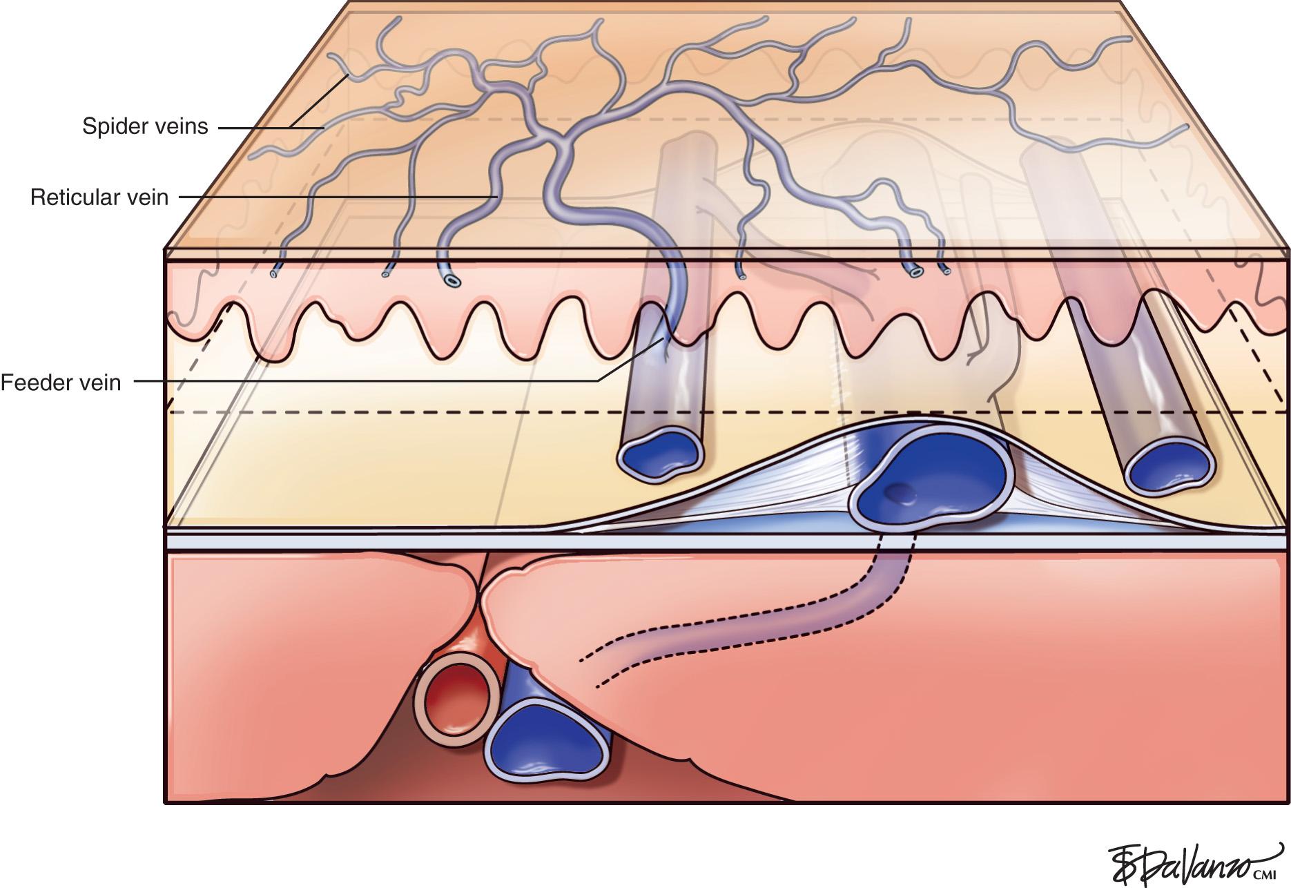 Fig. 23.1, Normal subcutaneous venous anatomy.