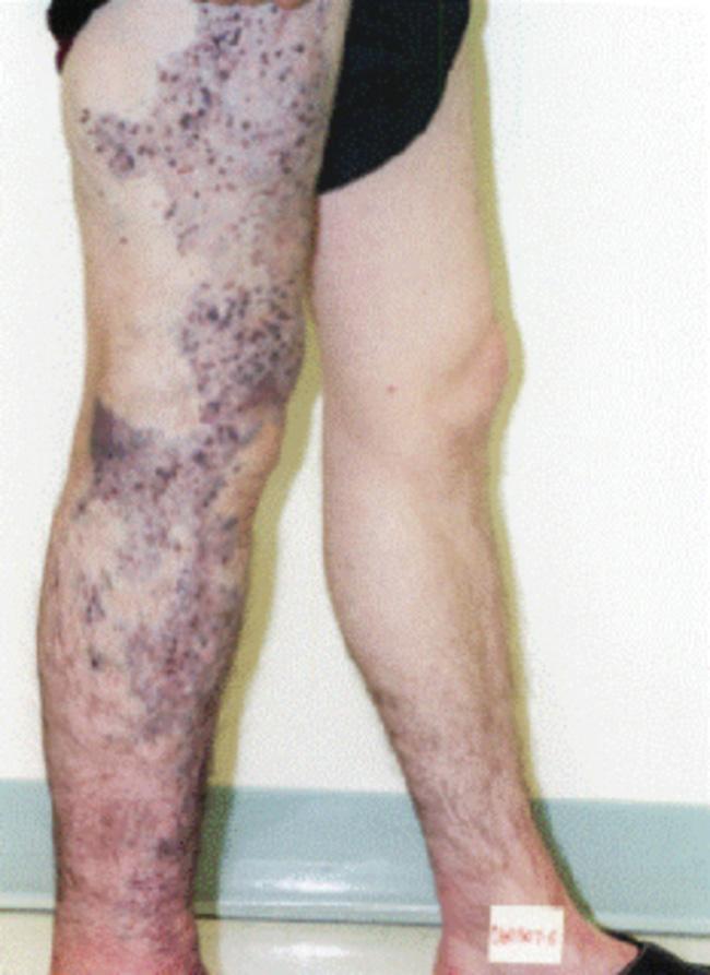 Fig. 23.2, Patient with Klippel-Trenaunay syndrome.