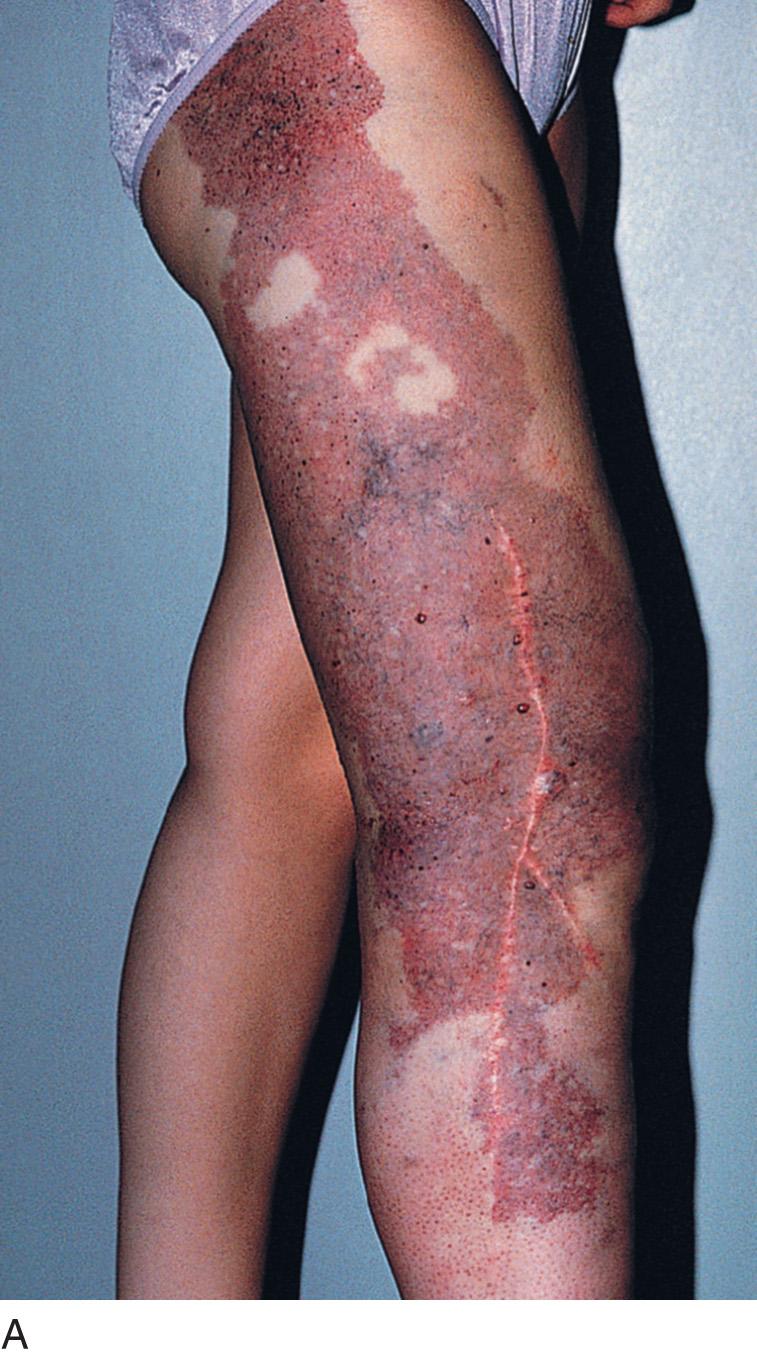 Fig. 23.5, (A, B) A 16-year-old female with Klippel-Trenaunay syndrome and associated varicose veins and nevus flammeus of the right lower extremity from the toes to the buttock.