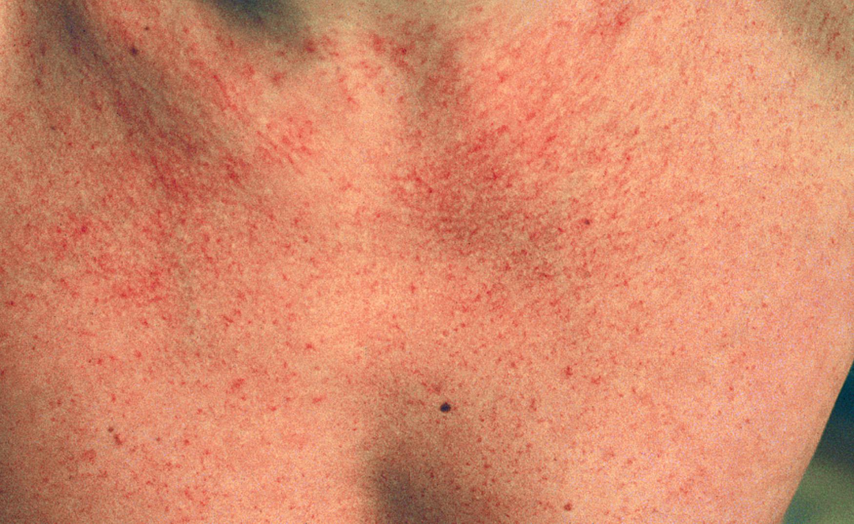 Fig. 23.6, Extensive fine red telangiectasia on the chest of a severely sun-damaged 50-year-old woman.