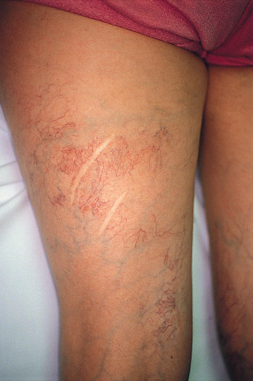 Fig. 23.7, This woman underwent an extensive ligation and stripping of her varicose veins at 18 years of age. She developed extensive telangiectasia around all the surgical sites within weeks of the surgical procedure. This photograph was taken 22 years after the surgical procedure.