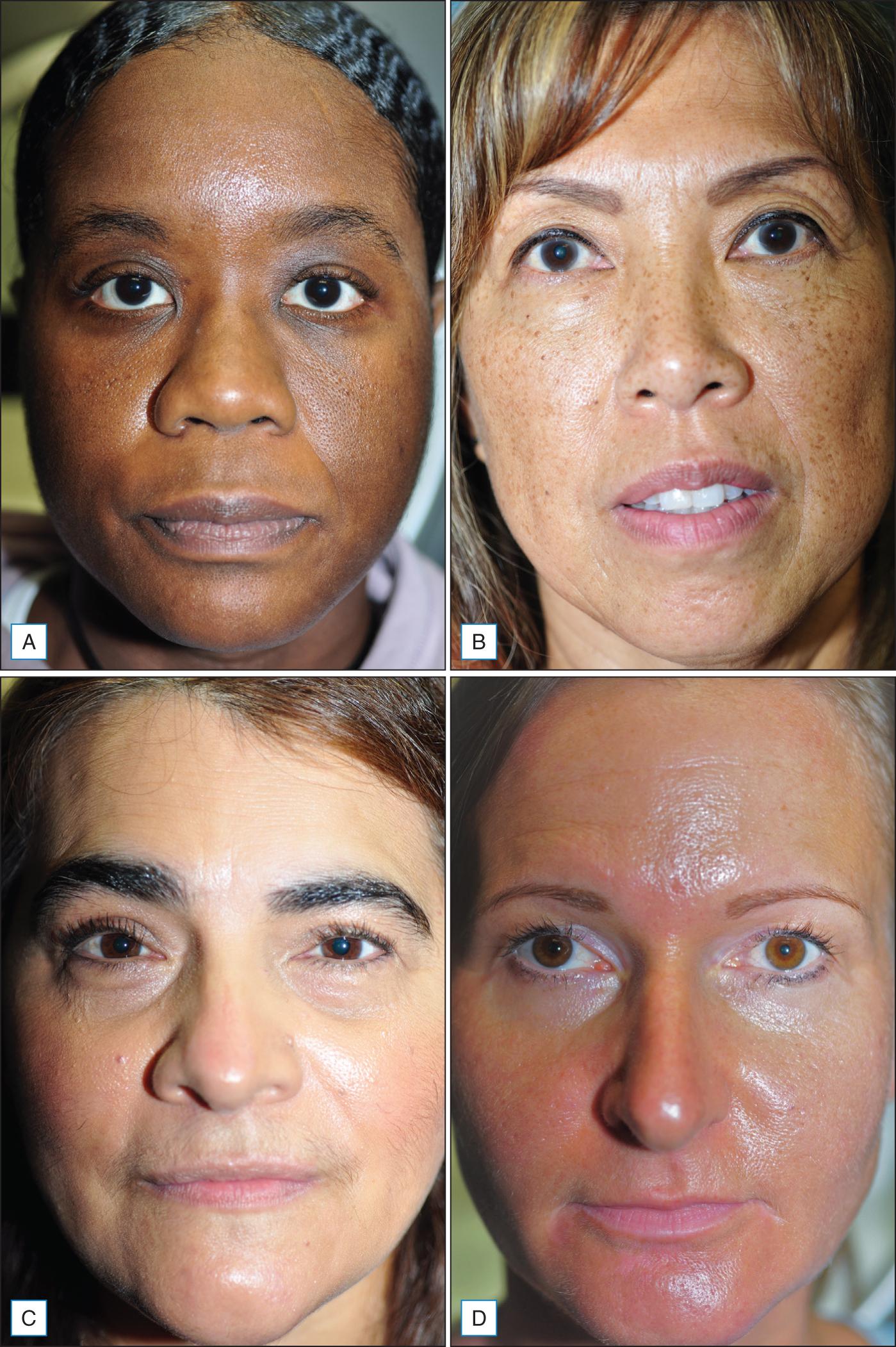 Fig. 24.1, Facial aging in an (A) African American woman, (B) Asian woman, (C) Hispanic woman, and (D) Caucasian woman who are between 50 and 60 years of age. Note the prominent nasolabial folds in the African American patient, the accumulation of lentigines in the Asian patient, and the infraorbital hollowing in the Hispanic patient, as compared to more rhytides in the Caucasian patient.