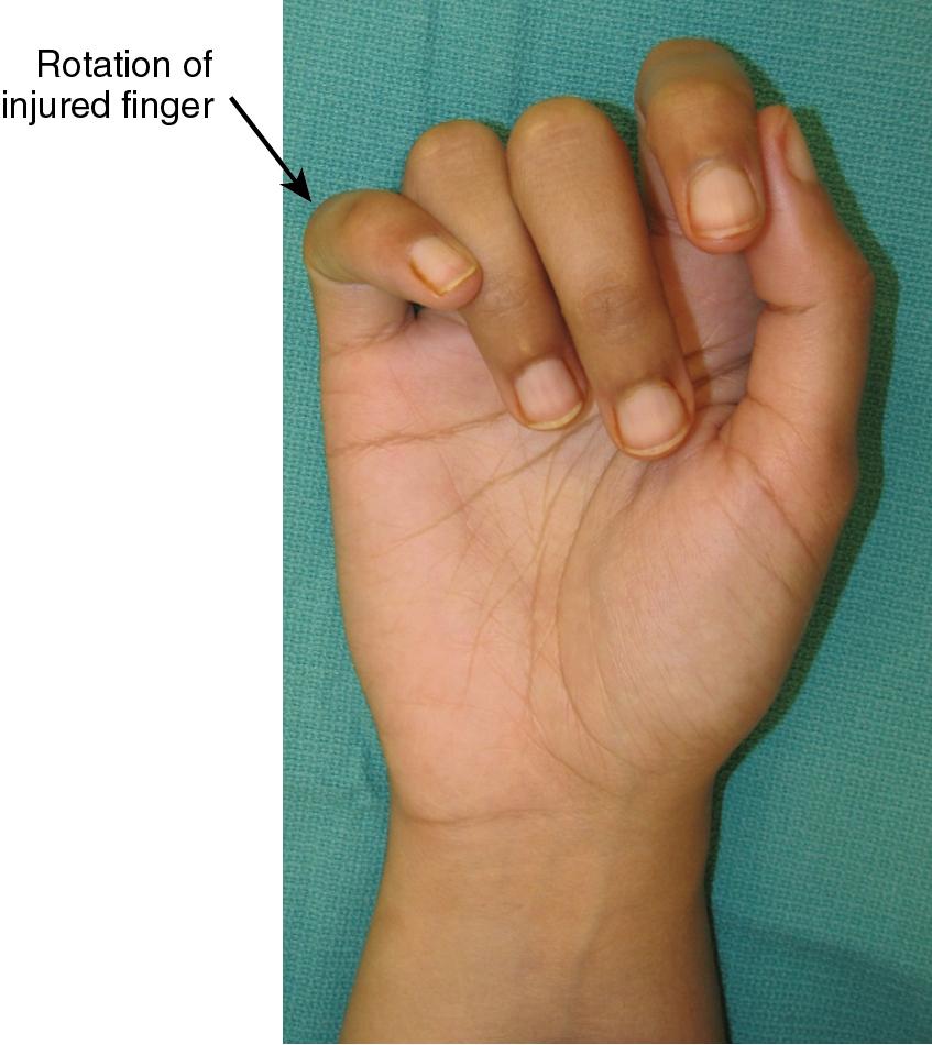 FIGURE 9.1, Note the rotational difference of the injured small finger compared with the remaining fingers.