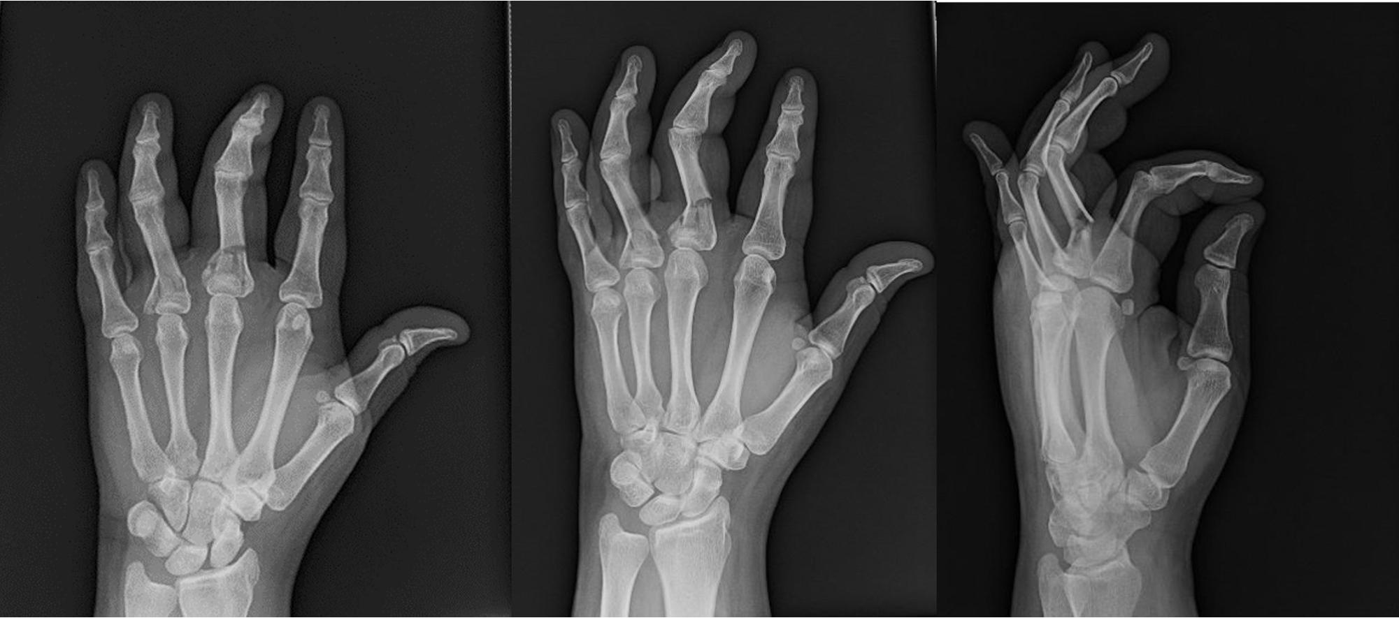 FIGURE 9.3, Preoperative x-rays.