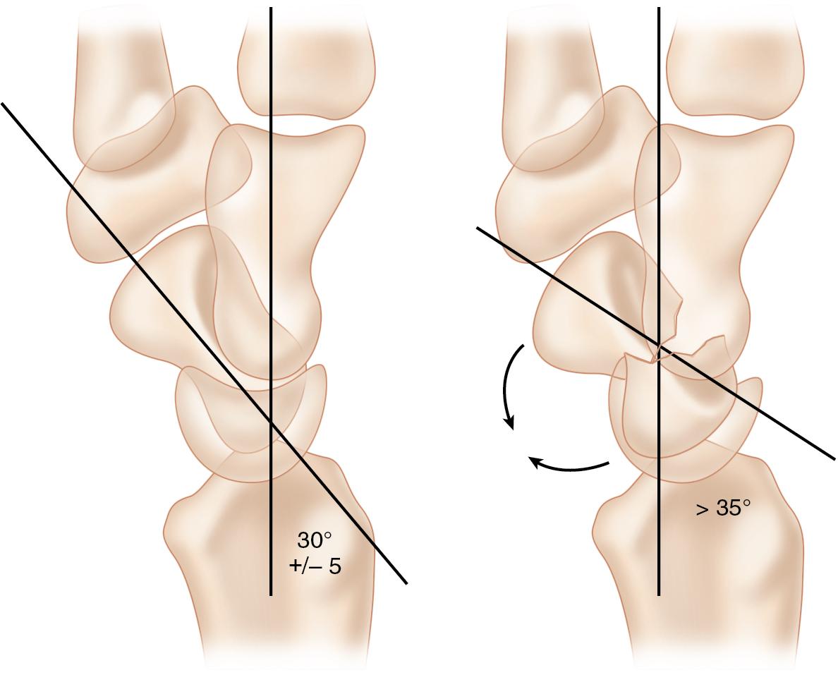 FIGURE 26.1, Intrascaphoid angle.