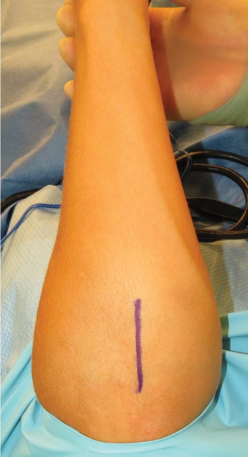 FIGURE 26.11, Incision marking for ulnar graft harvest.