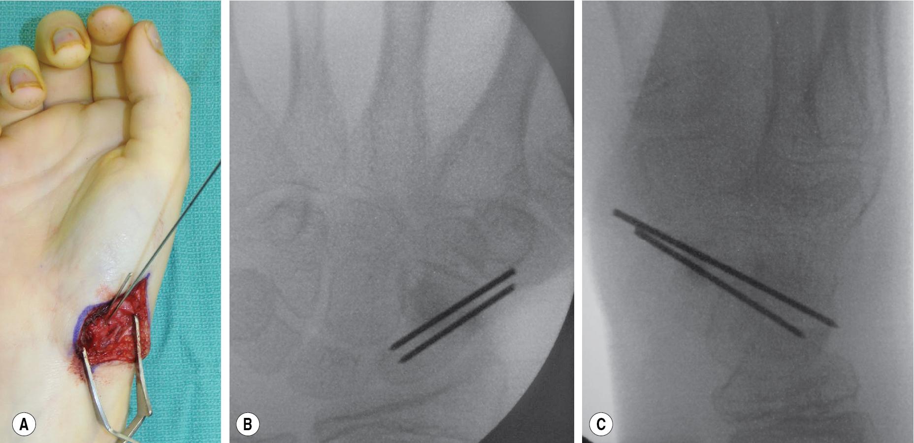 FIGURE 26.14, (A) K-wire placed in scaphoid. (B–C) Fluoroscopy confirms Kirschner wire (K-wire) position.