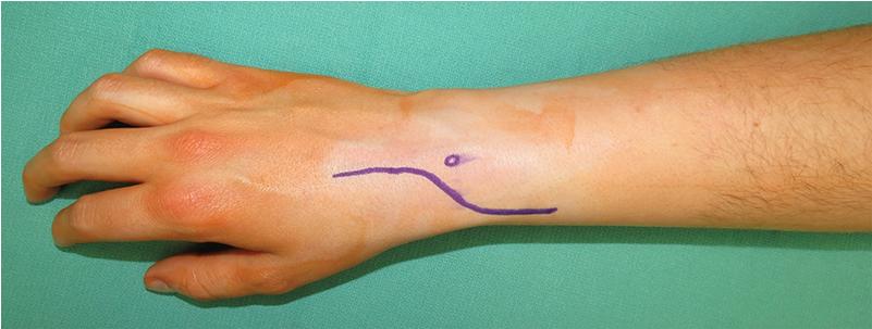 FIGURE 26.16, Curvilinear incision marking for dorsal approach.