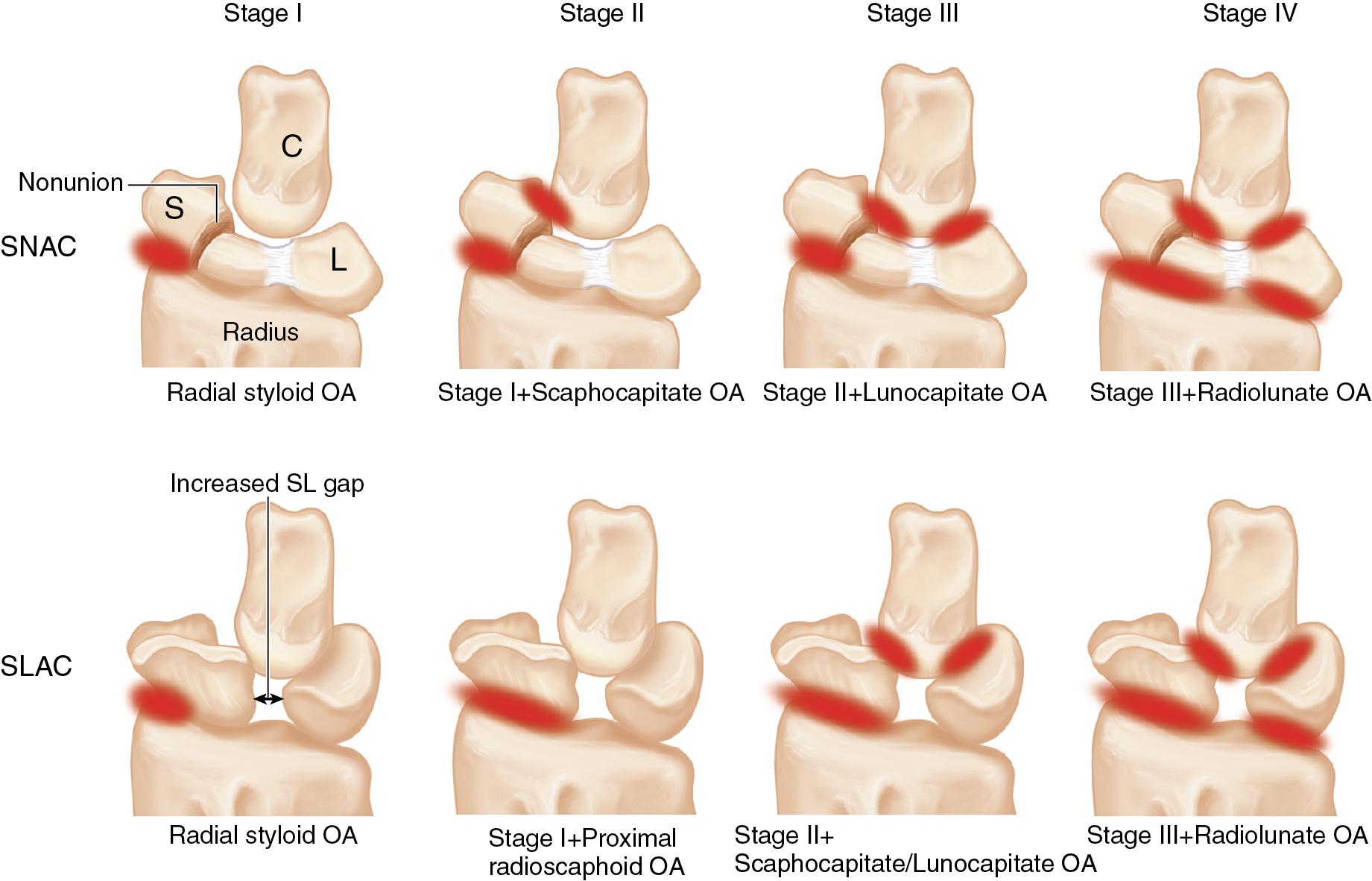 FIGURE 26.2, Scaphoid nonunion advanced collapse (SNAC).