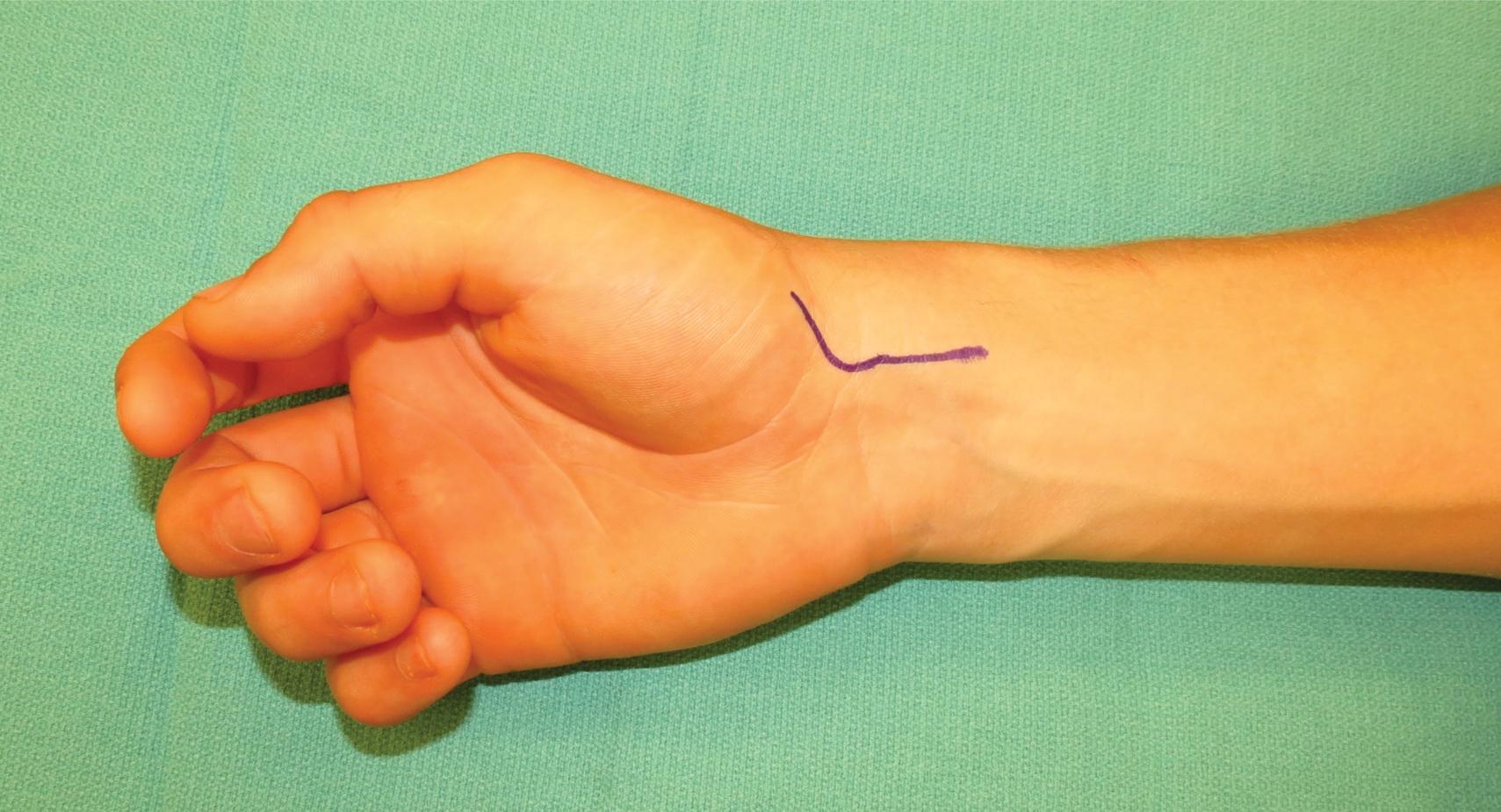 FIGURE 26.6, Incision marking for volar approach.