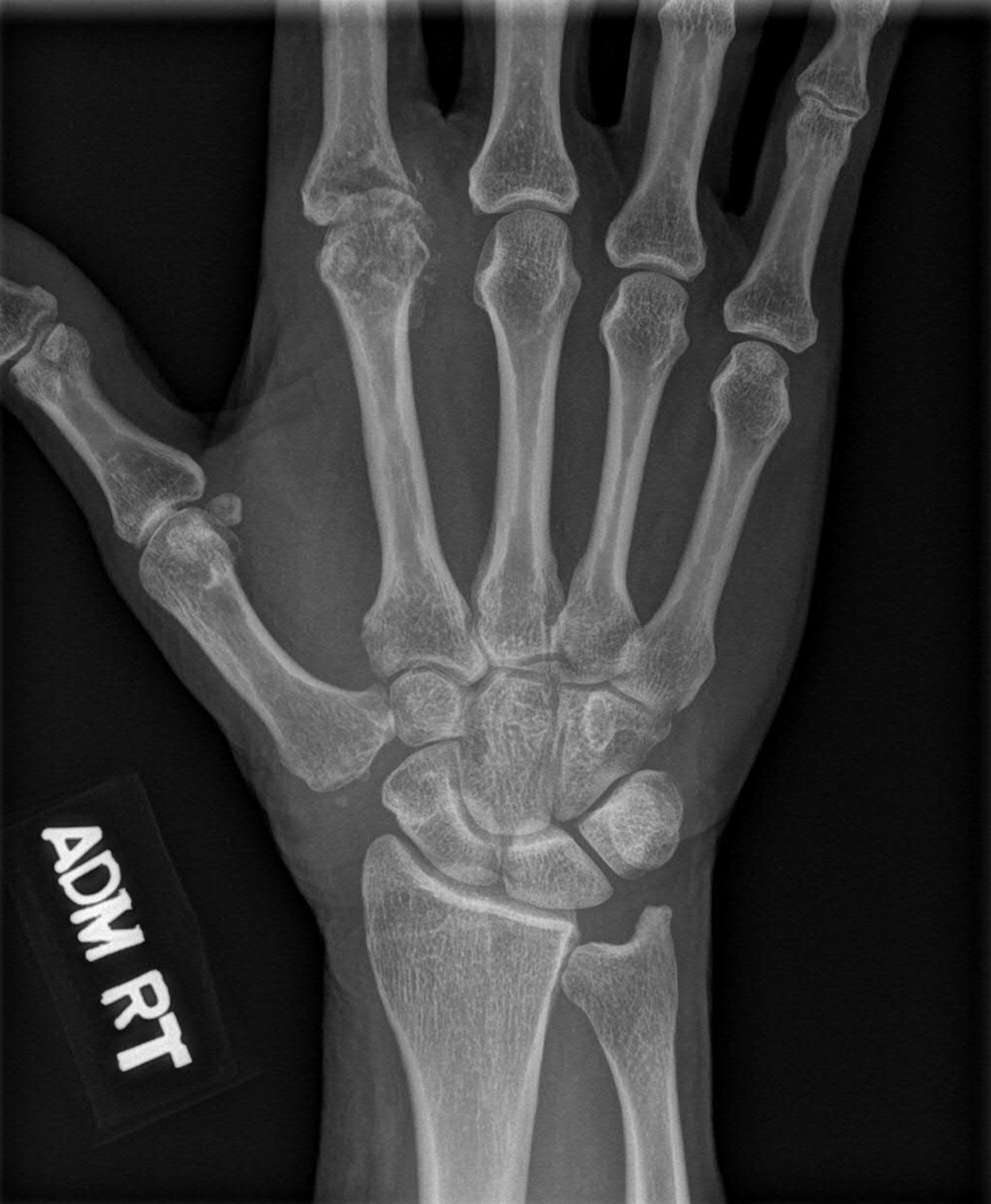 Fig. 11.1, A 51-year-old right hand dominant female with a 1-year history of right index finger pain located at the MCP joint.