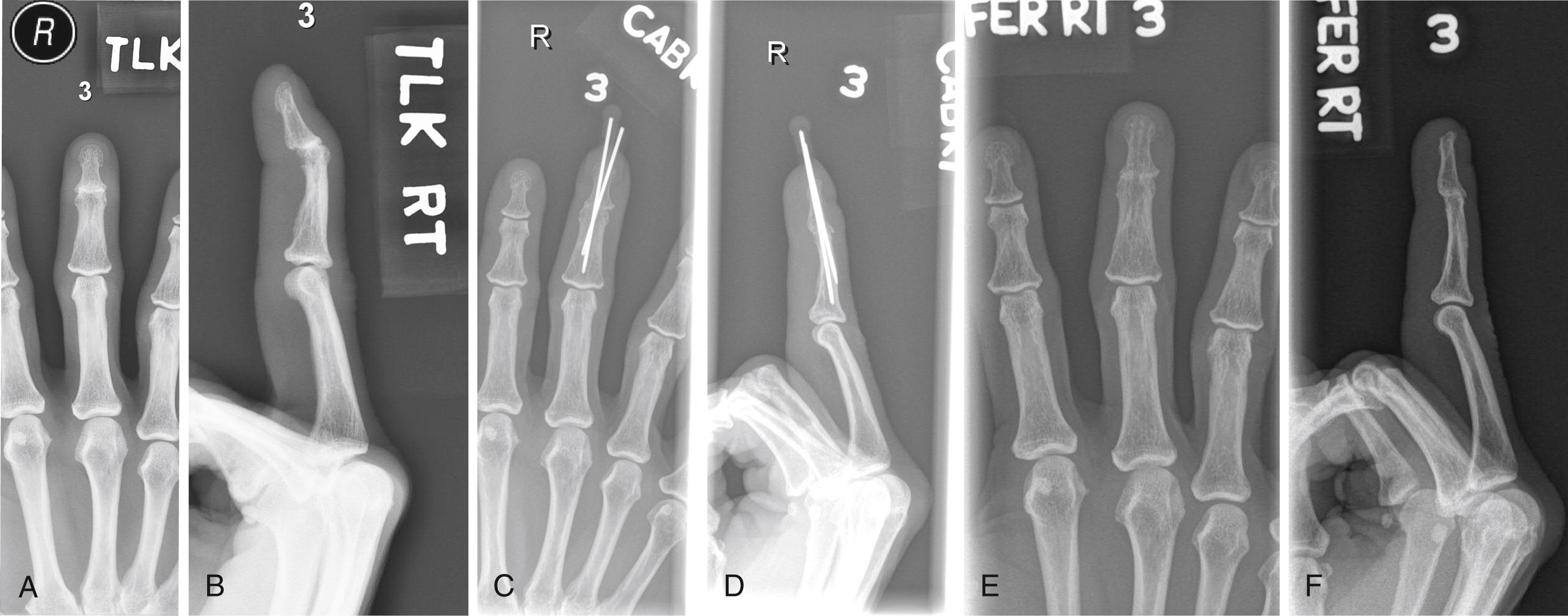 Fig. 11.3, A and B, Preoperative radiographs of a 55-year-old female with distal interphalangeal (DIP) joint destruction following septic arthritis caused by an infected mucous cyst. C and D, Postoperative radiographs following DIP joint arthrodesis with Kirshner wire stabilization. E and F, Final follow-up radiographs of healed DIP joint arthrodesis.